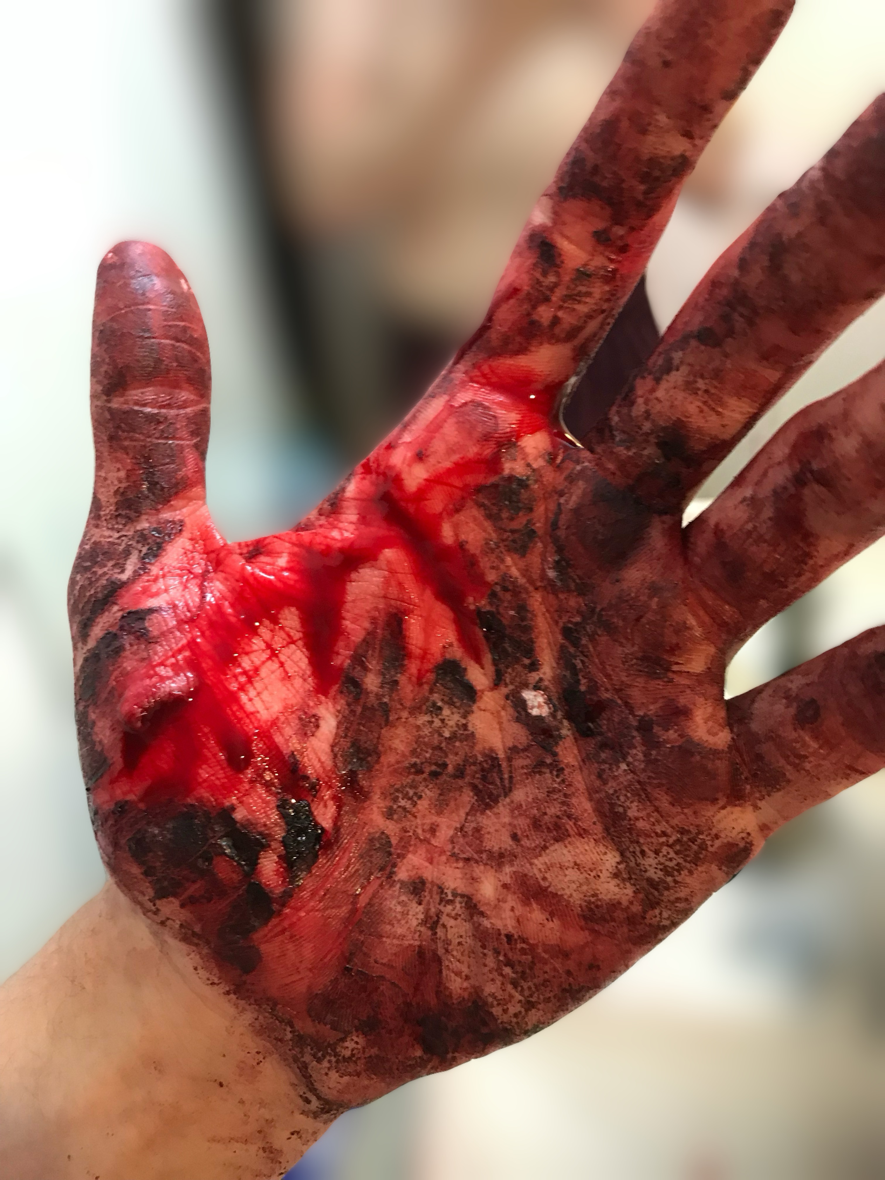 A photograph documenting an injury after the mirror accident.